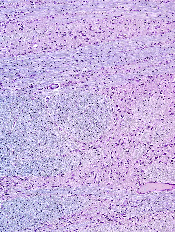 1C3 Crossed cerebellar atrophy, Infarct, agenesis corpus callosum (Case 1) FB-PAS 721