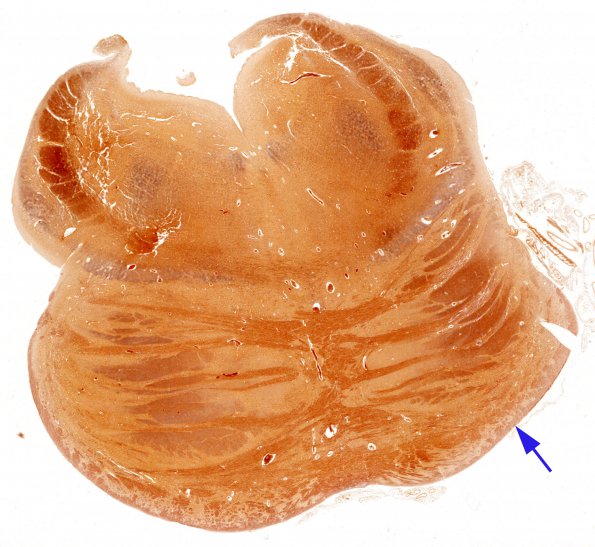 1D Crossed cerebellar atrophy, Infarct, agenesis corpus callosum (Case 1) N7 (right notch) Biels