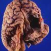 2A1 Crossed Cerebellar Atrophy (Case 2) 3