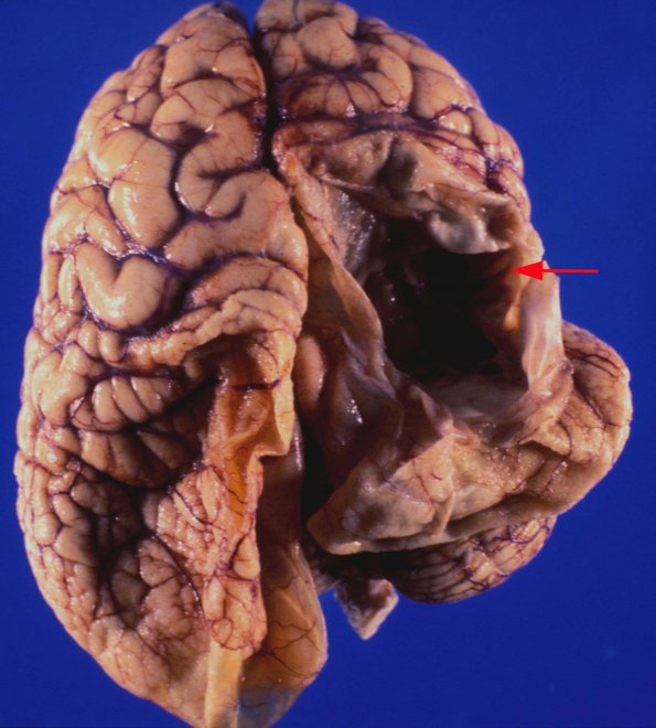 2A1 Crossed Cerebellar Atrophy (Case 2) 3