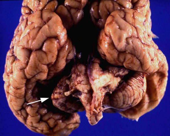 2A2 Crossed Cerebellar Atrophy (Case 2) 2