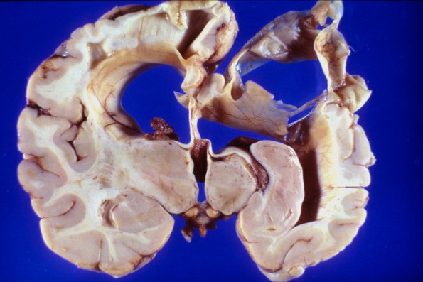 3A2 Porencephaly & crossed cerebellar atrophy (Case 3) gross 4