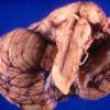 3A3 Porencephaly & crossed cerebellar atrophy (Case 3) gross 2