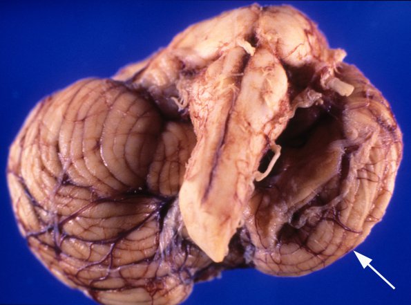 3A3 Porencephaly & crossed cerebellar atrophy (Case 3) gross 2