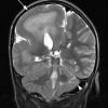 4A Hemimegalencephaly (Case 4) T2 1