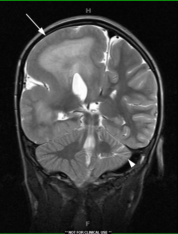 4A Hemimegalencephaly (Case 4) T2 1