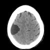 10A1 Cyst, arachnoid (Case 10) CT - Copy