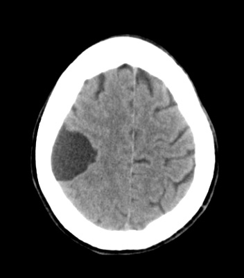 10A1-Cyst-arachnoid-Case-10-CT-Copy