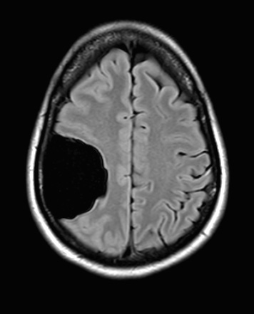 10A2-Cyst-arachnoid-Case-10-FLAIR-Copy