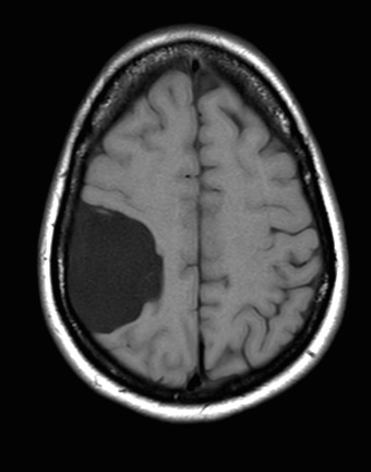 10A3-Cyst-arachnoid-Case-10-T1noC-Copy