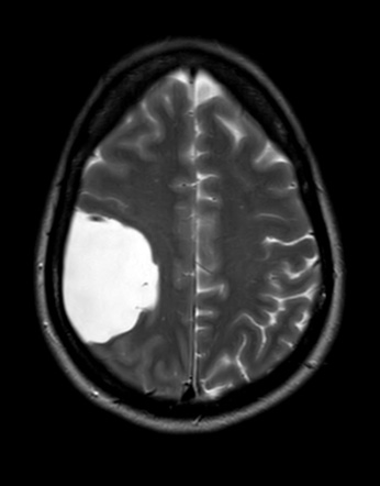 10A4-Cyst-arachnoid-Case-10-T2noC-A-Copy