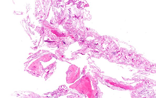 10B1-Cyst-arachnoid-Case-10-H-E-4X