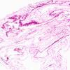 10B2 Cyst, arachnoid (Case 10) H&E 10X