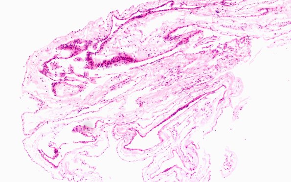 10B2-Cyst-arachnoid-Case-10-H-E-10X