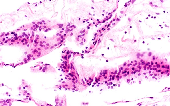 10B3 Cyst, arachnoid (Case 10) H&E 40X