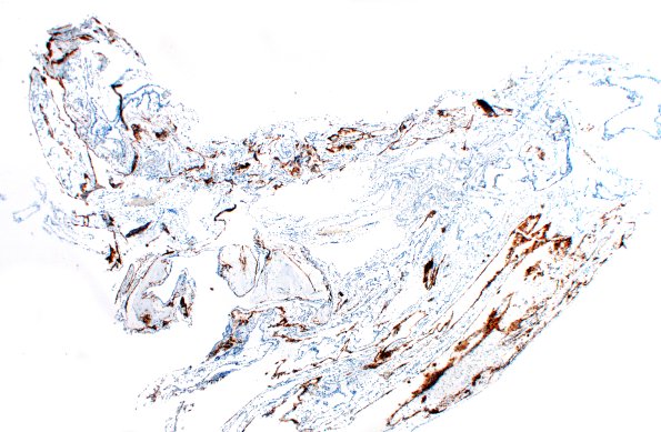 10C1 Cyst, arachnoid (Case 10) EMA 2X