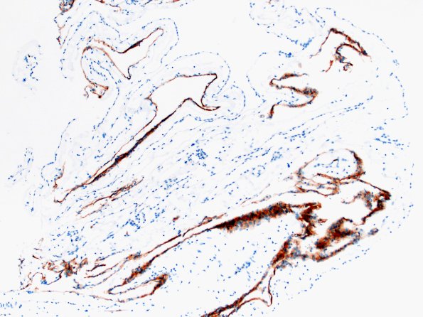 10C3-Cyst-arachnoid-Case-10-EMA-10X-3