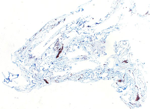 10D1 Cyst, arachnoid (Case 10) PR 2X