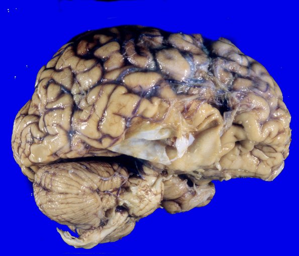 11A1 Cyst, arachnoid (Case 11) 2