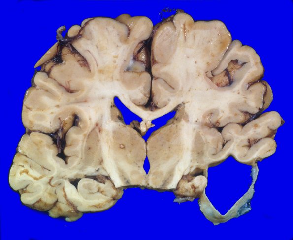 11A3 Cyst, arachnoid (Case 11) 3