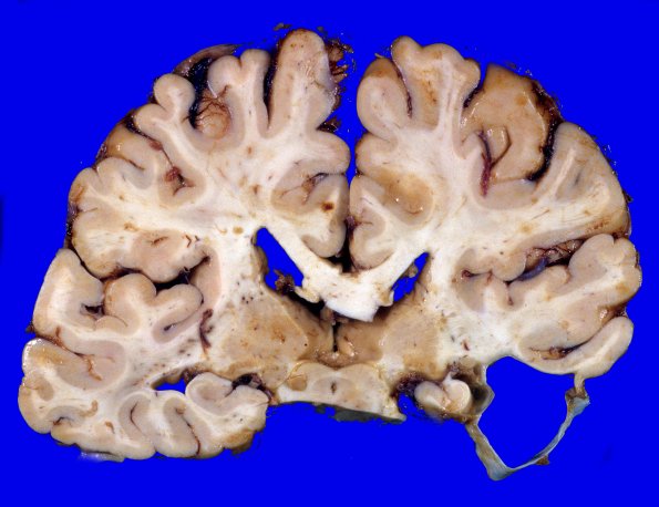 11A4 Cyst, arachnoid (Case 11) 4