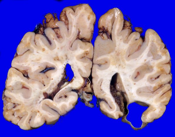 11A5 Cyst, arachnoid (Case 11) 5