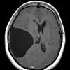 1A1 Cyst, Arachnoid (Case 1) T1 3