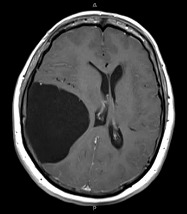 1A1 Cyst, Arachnoid (Case 1) T1 3