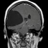 1A2 Cyst, Arachnoid (Case 1) T1 2