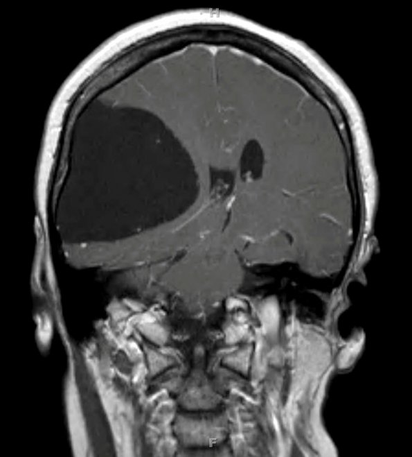 1A2 Cyst, Arachnoid (Case 1) T1 2