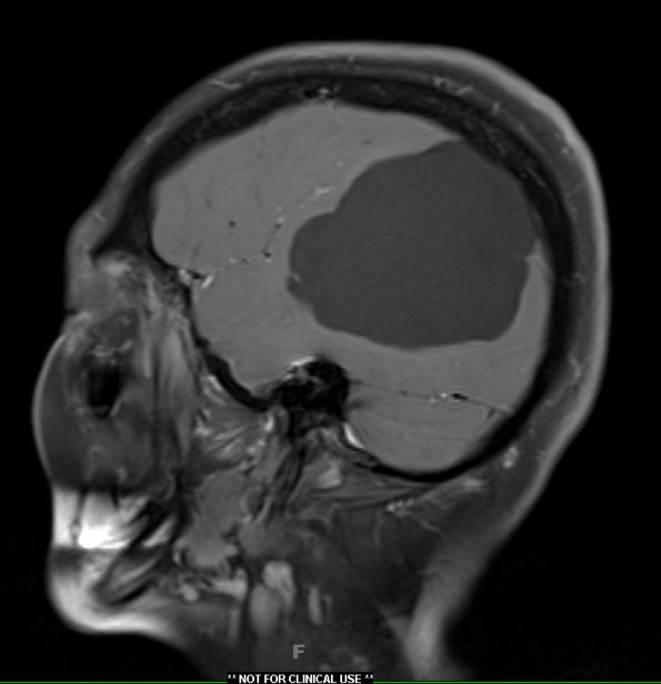 1A3 Arachnoid Cyst (Case 1) T1 W