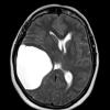 1A4 Cyst, Arachnoid (Case 1) T2