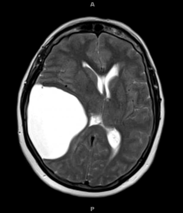 1A4 Cyst, Arachnoid (Case 1) T2