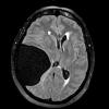 1A5 Cyst, Arachnoid (Case 1) FLAIR