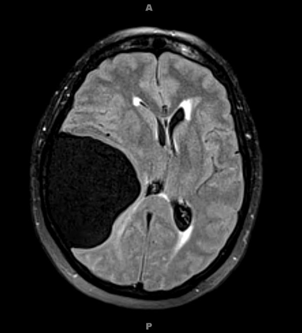 1A5 Cyst, Arachnoid (Case 1) FLAIR