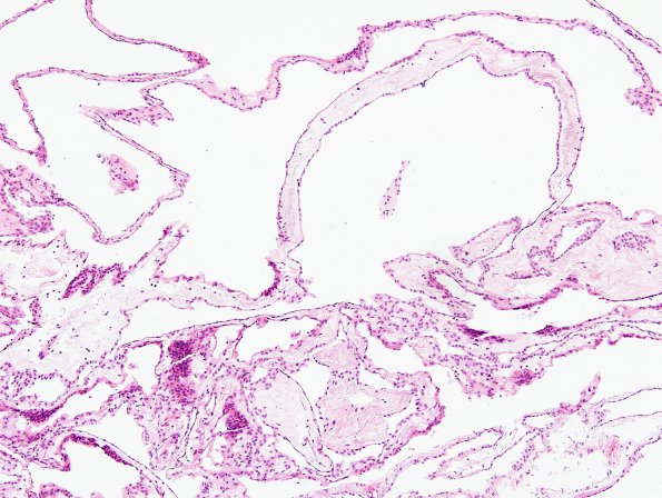 1B1 Cyst, Arachnoid (Case 1) H&E 3