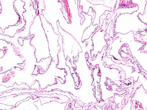 1B2 Cyst, Arachnoid (Case 1) H&E 2