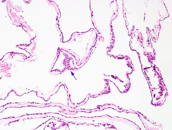 1B3 Cyst, Arachnoid (Case 1) H&E 1