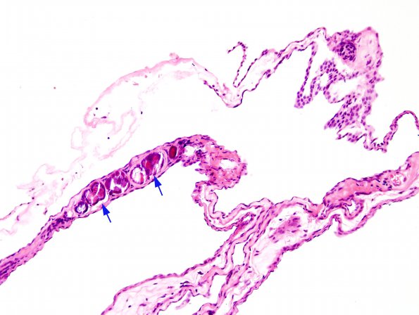 1B4 Cyst, Arachnoid (Case 1) H&E 7