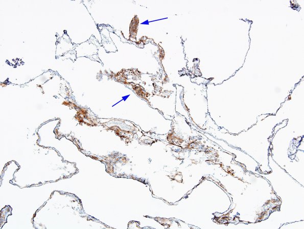 1C1 Cyst, Arachnoid (Case 1) EMA 4