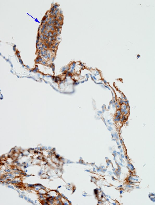 1C2 Cyst, Arachnoid (Case 1) EMA 2