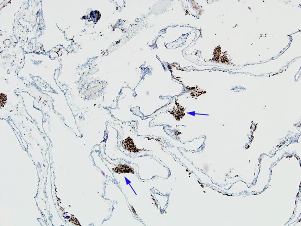 1C3 Cyst, Arachnoid (Case 1) PR 4