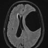 2A1 Cyst, arachnoid (Case 2) FLAIR