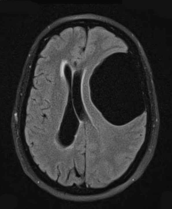 2A1 Cyst, arachnoid (Case 2) FLAIR