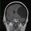 2A2 Cyst, arachnoid (Case 2) T1 W