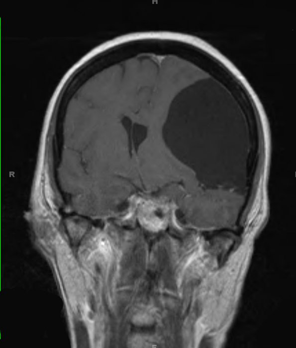 2A2 Cyst, arachnoid (Case 2) T1 W