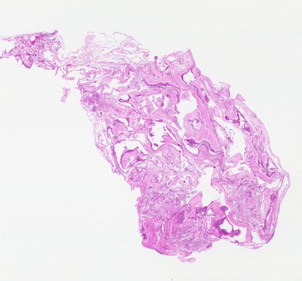 2B1 Cyst, arachnoid (Case 2) H&E whole mount