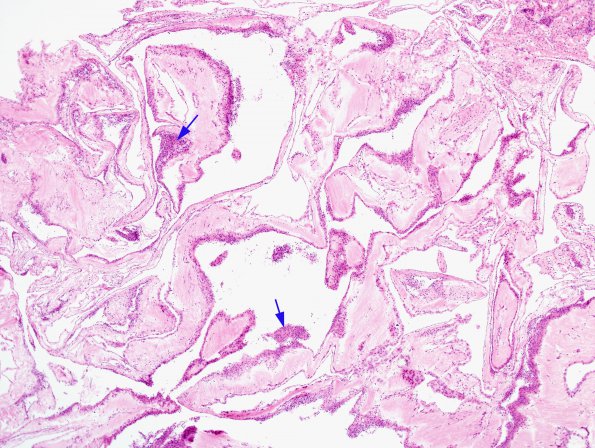 2B2 Cyst, arachnoid (Case 2) H&E 1