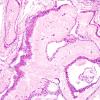 2B3 Cyst, arachnoid (Case 2) H&E 2