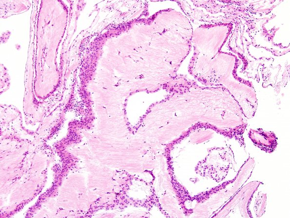 2B3 Cyst, arachnoid (Case 2) H&E 2